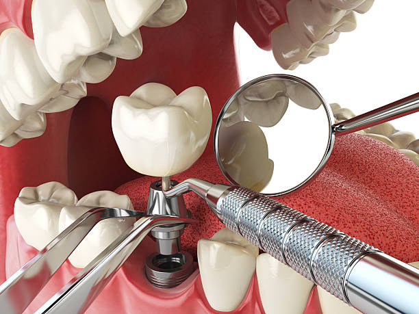 Best Emergency Root Canal Treatment in Spotswood, NJ